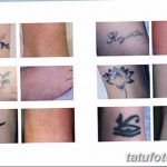 фото Выведение тату лазером от 14.01.2018 №048 - Laser tattoo removal - tatufoto.com