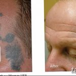 фото Выведение тату лазером от 14.01.2018 №054 - Laser tattoo removal - tatufoto.com