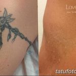 фото Выведение тату лазером от 14.01.2018 №055 - Laser tattoo removal - tatufoto.com