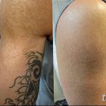 фото Выведение тату лазером от 14.01.2018 №056 - Laser tattoo removal - tatufoto.com