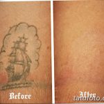 фото Выведение тату лазером от 14.01.2018 №057 - Laser tattoo removal - tatufoto.com