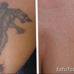 фото Выведение тату лазером от 14.01.2018 №058 - Laser tattoo removal - tatufoto.com