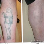 фото Выведение тату лазером от 14.01.2018 №059 - Laser tattoo removal - tatufoto.com