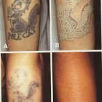 фото Выведение тату лазером от 14.01.2018 №060 - Laser tattoo removal - tatufoto.com