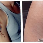 фото Выведение тату лазером от 14.01.2018 №061 - Laser tattoo removal - tatufoto.com