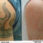 фото Выведение тату лазером от 14.01.2018 №062 - Laser tattoo removal - tatufoto.com