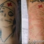 фото Выведение тату лазером от 14.01.2018 №063 - Laser tattoo removal - tatufoto.com