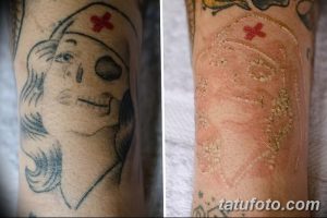 Фото татуировки медсестры на руке до и после удаления лазером. Видно значительное осветление рисунка.