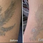 фото Выведение тату лазером от 14.01.2018 №065 - Laser tattoo removal - tatufoto.com