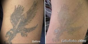 Фото татуировки орла на руке до и после удаления лазером. Видно значительное осветление рисунка.