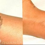 фото Выведение тату лазером от 14.01.2018 №067 - Laser tattoo removal - tatufoto.com