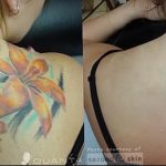 фото Выведение тату лазером от 14.01.2018 №068 - Laser tattoo removal - tatufoto.com