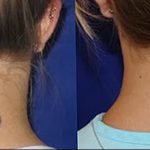 фото Выведение тату лазером от 14.01.2018 №070 - Laser tattoo removal - tatufoto.com