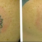 фото Выведение тату лазером от 14.01.2018 №071 - Laser tattoo removal - tatufoto.com