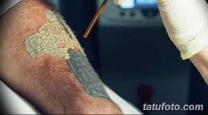 Фото тату: процесс лазерного удаления татуировки на руке. Виден лазерный луч, направленный на татуировку, и рука пациента в перчатке.