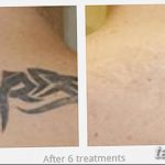 фото Выведение тату лазером от 14.01.2018 №073 - Laser tattoo removal - tatufoto.com