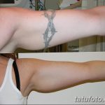 фото Выведение тату лазером от 14.01.2018 №074 - Laser tattoo removal - tatufoto.com