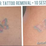 фото Выведение тату лазером от 14.01.2018 №075 - Laser tattoo removal - tatufoto.com