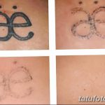 фото Выведение тату лазером от 14.01.2018 №076 - Laser tattoo removal - tatufoto.com