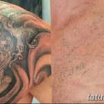 фото Выведение тату лазером от 14.01.2018 №077 - Laser tattoo removal - tatufoto.com