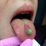 фото Пирсинг языка от 03.02.2018 №061 - tongue piercing - tatufoto.com