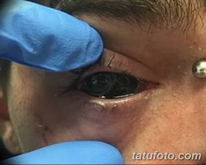 Фотография процесса татуировки склер глаза. Виден глаз пациента и рука мастера в перчатке, вводящая краску.