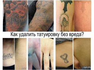 Коллаж фотографий, демонстрирующий процесс удаления татуировок лазером. Видны татуировки до удаления и после нескольких сеансов, с осветлением и исчезновением рисунков.