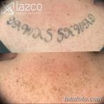 Фото удаление татуировки 21.11.2018 №001 - photo tattoo removal - tatufoto.com