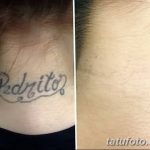 Фото удаление татуировки 21.11.2018 №003 - photo tattoo removal - tatufoto.com