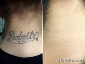 Фото тату надписи на шее до и после удаления. Видна разница между четкой надписью и чистой кожей. Процесс удаления татуировки.