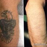 Фото удаление татуировки 21.11.2018 №004 - photo tattoo removal - tatufoto.com