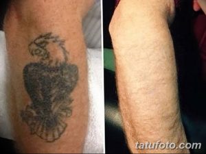 Фото тату с орлом на предплечье до и после удаления. Видна разница между рисунком и чистой кожей. Процесс удаления татуировки.