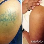 Фото удаление татуировки 21.11.2018 №005 - photo tattoo removal - tatufoto.com