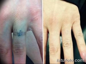 Фото тату надписи на пальце до и после удаления. Видна разница между четкой надписью и чистой кожей. Процесс удаления татуировки.