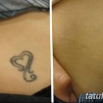 Фото удаление татуировки 21.11.2018 №007 - photo tattoo removal - tatufoto.com