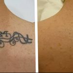 Фото удаление татуировки 21.11.2018 №008 - photo tattoo removal - tatufoto.com
