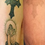 Фото удаление татуировки 21.11.2018 №009 - photo tattoo removal - tatufoto.com