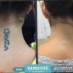 Фото удаление татуировки 21.11.2018 №011 - photo tattoo removal - tatufoto.com