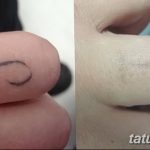 Фото удаление татуировки 21.11.2018 №012 - photo tattoo removal - tatufoto.com
