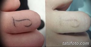 Фотография демонстрирует удаление небольшой татуировки на пальце. Слева - татуировка до удаления, справа - кожа после процедуры.