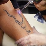 Фото удаление татуировки 21.11.2018 №014 - photo tattoo removal - tatufoto.com