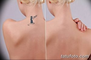 Фотография демонстрирует небольшую татуировку ангела на спине, до и после процедуры удаления. Виден контур крыльев и силуэт фигуры.