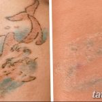 Фото удаление татуировки 21.11.2018 №017 - photo tattoo removal - tatufoto.com