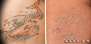 Фотография демонстрирует выцветшую татуировку с изображением волны и рыбы на руке. Слева - татуировка в исходном состоянии, справа - после выцветания.