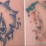 Фото удаление татуировки 21.11.2018 №018 - photo tattoo removal - tatufoto.com