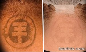 Фотография демонстрирует удаление татуировки с изображением лица на шее. Слева - татуировка до удаления, справа - кожа после процедуры.