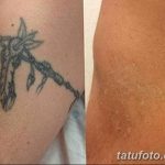 Фото удаление татуировки 21.11.2018 №020 - photo tattoo removal - tatufoto.com