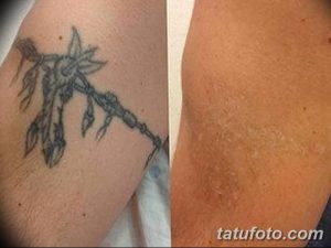 Фотография демонстрирует процесс удаления татуировки с цветком на руке. Слева - татуировка до удаления, справа - кожа после процедуры.