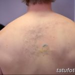 Фото удаление татуировки 21.11.2018 №022 - photo tattoo removal - tatufoto.com