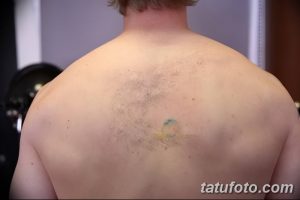 Фото старой татуировки на спине до и после удаления. Сравнение состояния кожи до и после лазерного удаления татуировки.